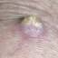 13. Skin Cancer Pictures