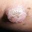 15. Skin Cancer Pictures