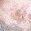 17. Skin Cancer Pictures
