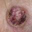 23. Skin Cancer Pictures