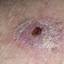 40. Skin Cancer Pictures
