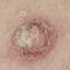 45. Skin Cancer Pictures