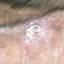 7. Skin Cancer Pictures