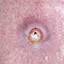 8. Skin Cancer Pictures