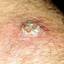 9. Skin Cancer Pictures