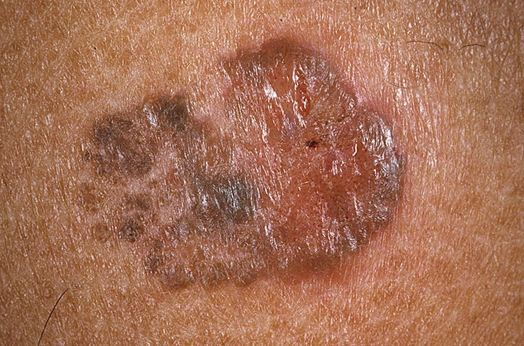 Skin Cancer Pictures – 54 Photos And Images