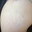 1. Stretch Marks on Thighs Pictures