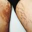 10. Stretch Marks on Thighs Pictures