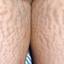 11. Stretch Marks on Thighs Pictures