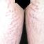 2. Stretch Marks on Thighs Pictures
