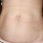 10. Stretch Marks Pictures
