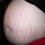 12. Stretch Marks Pictures