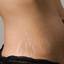 13. Stretch Marks Pictures