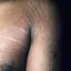14. Stretch Marks Pictures