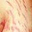2. Stretch Marks Pictures