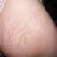 3. Stretch Marks Pictures