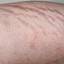 31. Stretch Marks Pictures