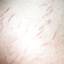 33. Stretch Marks Pictures