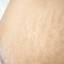 36. Stretch Marks Pictures