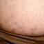 38. Stretch Marks Pictures