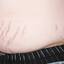 48. Stretch Marks Pictures