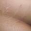 49. Stretch Marks Pictures