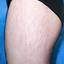 1. Striae on Thighs Pictures