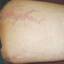 12. Stretch Marks on Legs Pictures