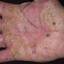 11. Dyshidrosis on Hands Pictures
