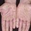 14. Dyshidrosis on Hands Pictures