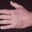 15. Dyshidrosis on Hands Pictures