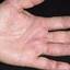 17. Dyshidrosis on Hands Pictures