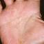 19. Dyshidrosis on Hands Pictures