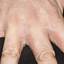 2. Dyshidrosis on Hands Pictures