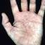 21. Dyshidrosis on Hands Pictures