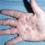22. Dyshidrosis on Hands Pictures