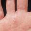 26. Dyshidrosis on Hands Pictures