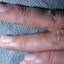 28. Dyshidrosis on Hands Pictures