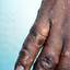 31. Dyshidrosis on Hands Pictures