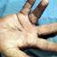 32. Dyshidrosis on Hands Pictures