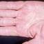 35. Dyshidrosis on Hands Pictures