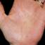 36. Dyshidrosis on Hands Pictures