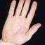 37. Dyshidrosis on Hands Pictures