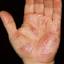 38. Dyshidrosis on Hands Pictures