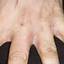 4. Dyshidrosis on Hands Pictures