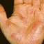 42. Dyshidrosis on Hands Pictures