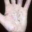 43. Dyshidrosis on Hands Pictures
