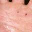 44. Dyshidrosis on Hands Pictures