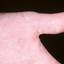 46. Dyshidrosis on Hands Pictures