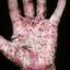 47. Dyshidrosis on Hands Pictures
